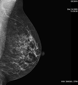 mammografia digitale a bologna