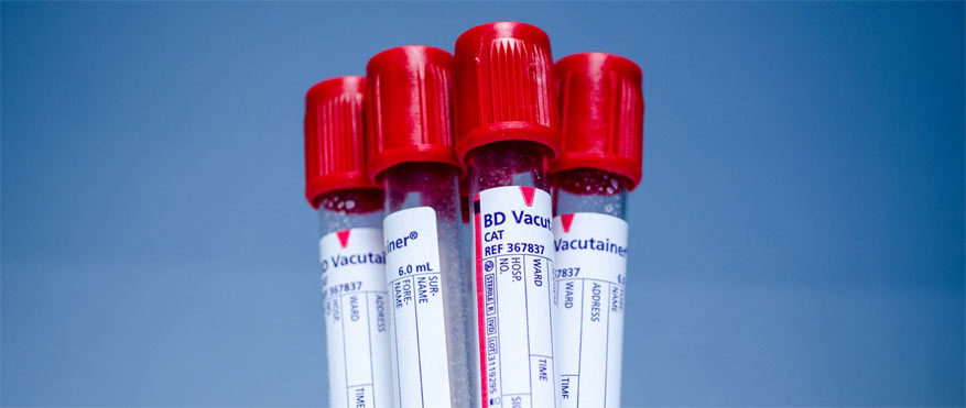 esami di laboratorio: analisi del sangue a bologna